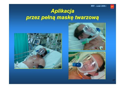 Wentylacja nieinwazyjna i rÃ³Å¼ne formy jej klinicznego zastosowania ...