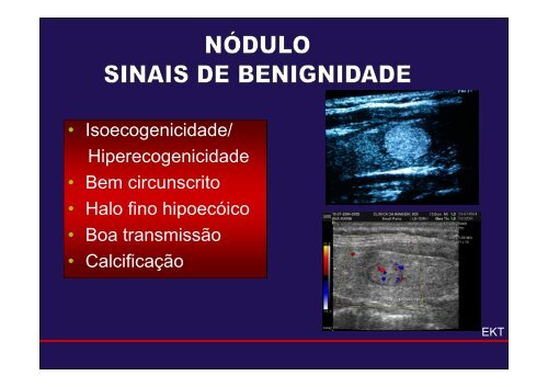 USG TIREOIDE ANN - Prof. Euderson Kang