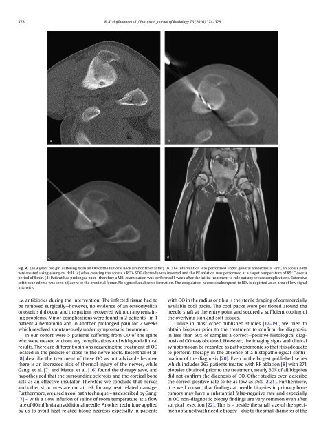 European Journal of Radiology Radiofrequency ablation in the ...