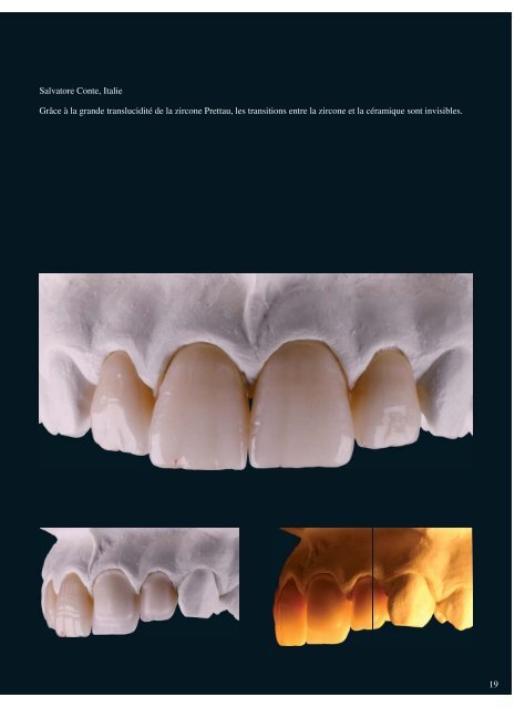 Coloration de la zircone Prettau - Zirkonzahn