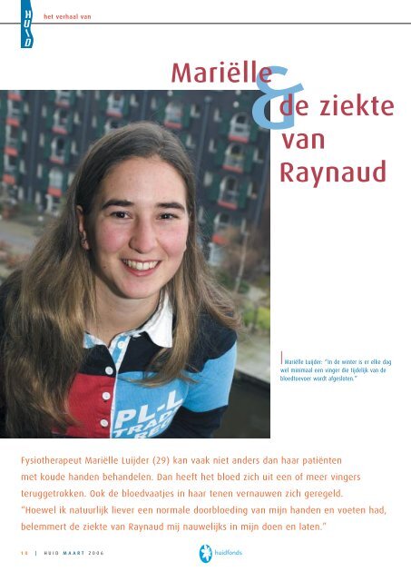 MariÃ«lle de ziekte van Raynaud - Huid Magazine