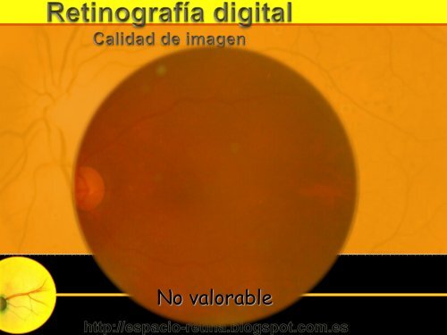 Interpretación de la Retinografía digital y F.O