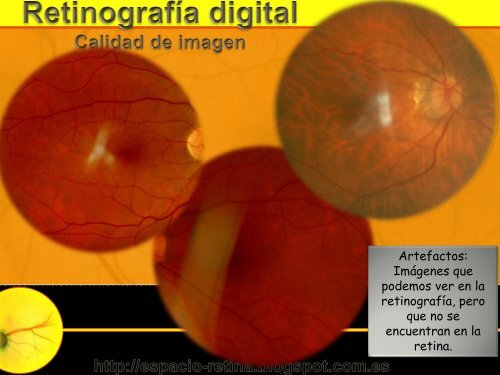 Interpretación de la Retinografía digital y F.O