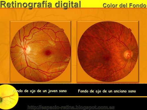 Interpretación de la Retinografía digital y F.O