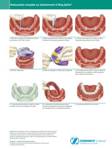 O-Ring Guide 4595.qxd - Zimmer Dental