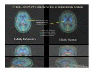 [F-18]-L-DOPA PET scan shows loss of dopaminergic neurons