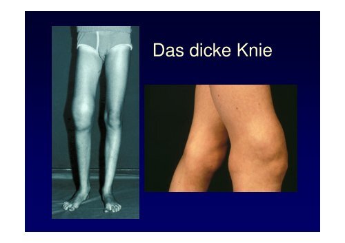 Vorlesung Leitsymptom Das dicke Knie