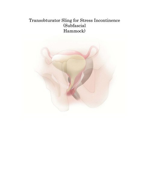 Transobturator Sling for Stress Incontinence (Subfascial Hammock)