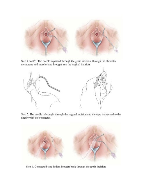 Transobturator Sling for Stress Incontinence (Subfascial Hammock)