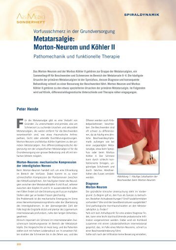 Metatarsalgie: Morton-Neurom und KÃ¶hler II - Spiraldynamik