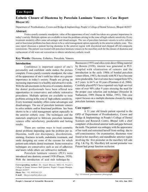 Esthetic Closure of Diastema by Porcelain Laminate Veneers: A ...