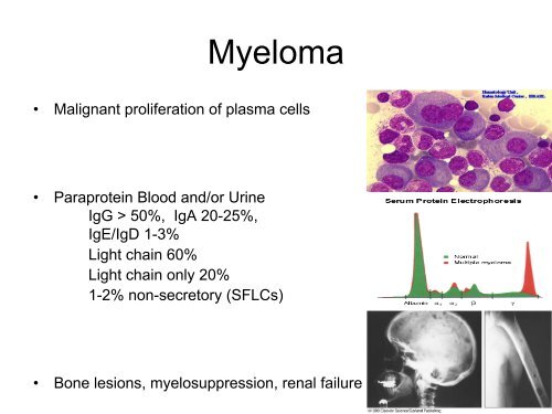 Clinical Update - Multiple Myeloma - Dr Grant McQuaker - BOPA