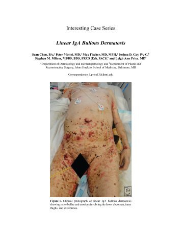 Interesting Case Series Linear IgA Bullous Dermatosis - ePlasty