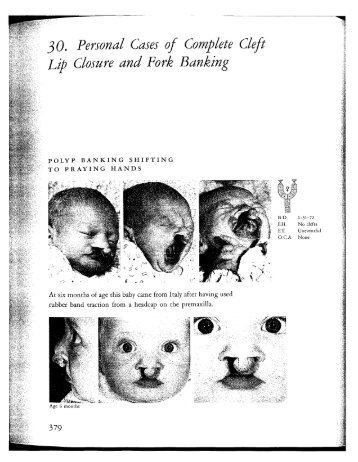 30. Personal Cases of Complete Cleft Lip Closure and Fork Banking ...