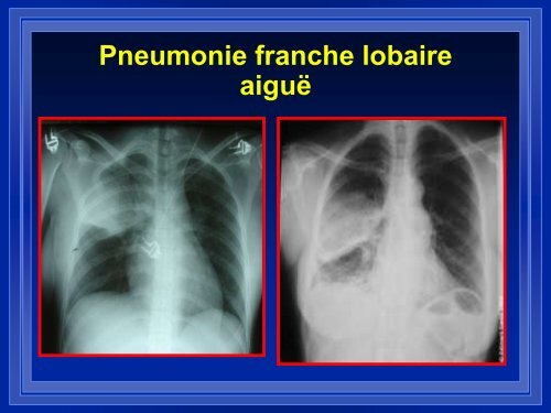 PNP communautaire grave - ATuRea