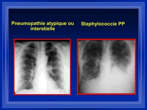 PNP communautaire grave - ATuRea