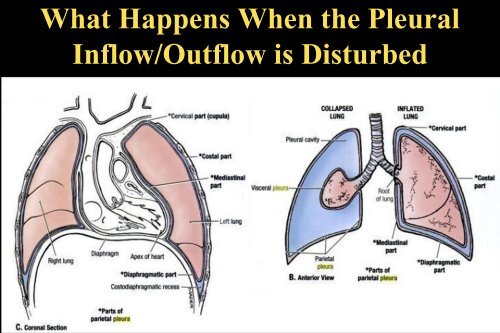 Malignant Pleural Effusions and Breast Cancer