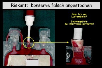 Konserven anwÃ¤rmen? Bitte nicht so !!! - Transfusionspraxis