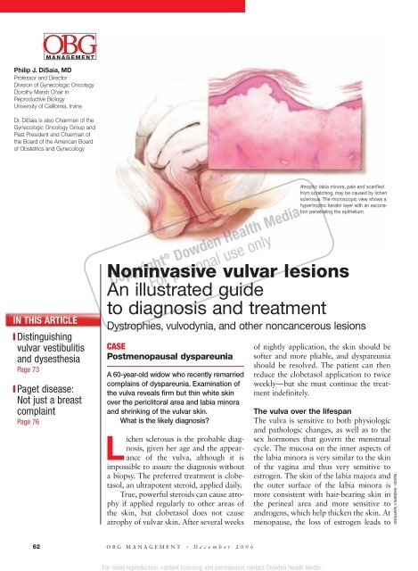 Noninvasive vulvar lesions An illustrated guide to ... - Urogyn.org