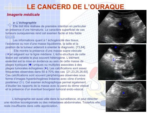 LE CANCERD DE L’OURAQUE
