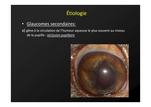 Le glaucome aigu - Association pour la Formation en Ophtalmologie ...