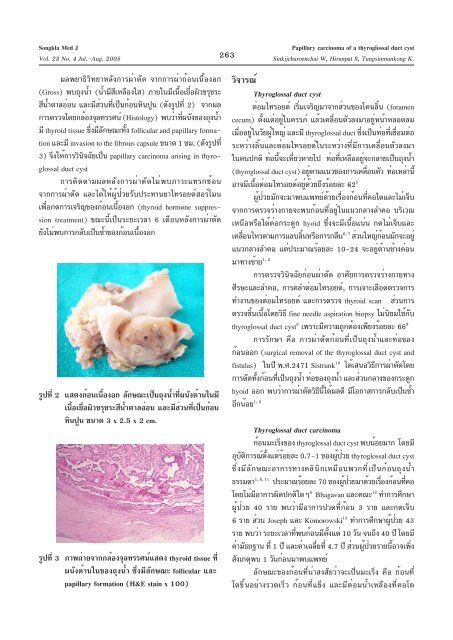 Papillary carcinoma à¸à¸­à¸ thyroglossal duct cyst: à¸à¸¹à¹à¸à¹à¸§à¸¢à¸£à¸²à¸¢à¹à¸£à¸ à¹à¸à¹à¸£à¸ ...