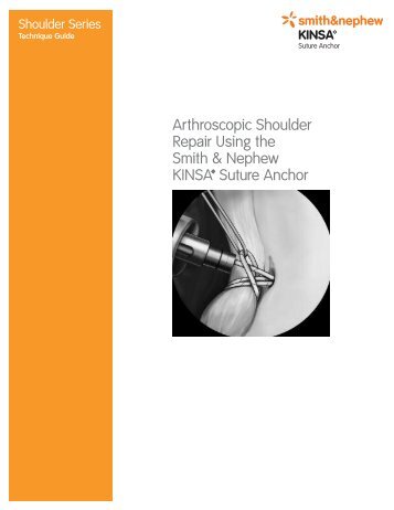 Arthroscopic Shoulder Repair Using the Smith & Nephew KINSA ...