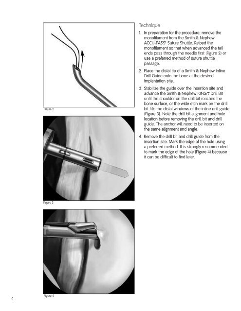 Arthroscopic Shoulder Repair Using the Smith & Nephew KINSA ...