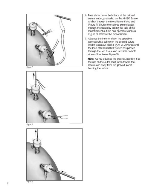 Arthroscopic Shoulder Repair Using the Smith & Nephew KINSA ...