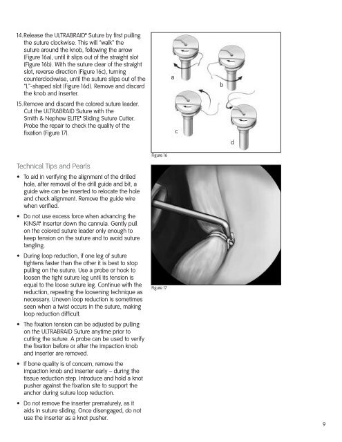 Arthroscopic Shoulder Repair Using the Smith & Nephew KINSA ...