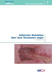 Infizierter Dekubitus Ã¼ber dem Trochanter major - Cutimed Sorbact