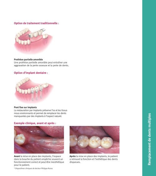 Education des patients - Zimmer Dental