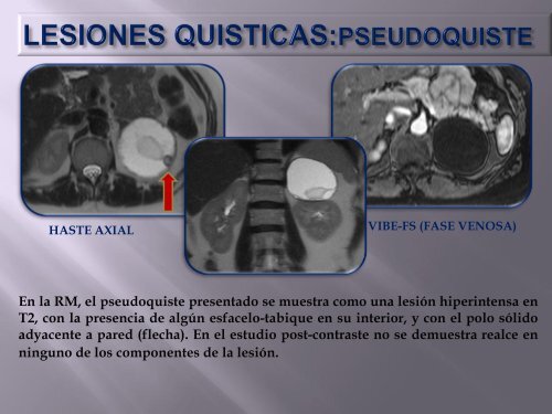 lesiones quisticas