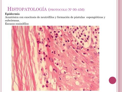 Dermatosis neutrofÃ­licas