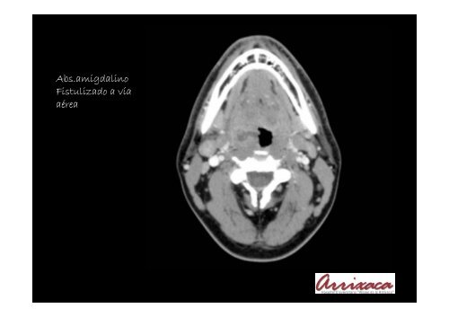 REVISIÓN DE LOS ABSCESOS CERVICALES. Utilidad de la TCMD