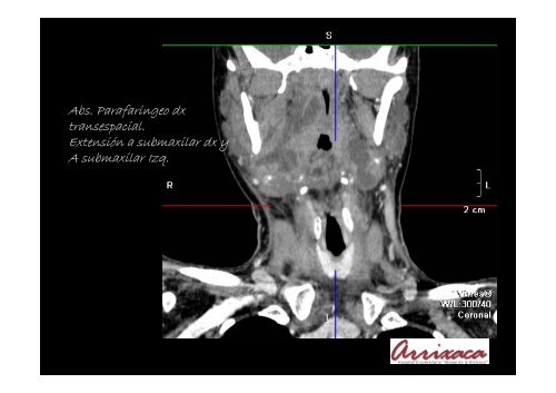 REVISIÓN DE LOS ABSCESOS CERVICALES. Utilidad de la TCMD