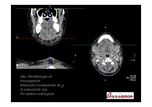 REVISIÓN DE LOS ABSCESOS CERVICALES. Utilidad de la TCMD