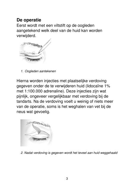 Huidteveel in de bovenoogleden - IJsselland Ziekenhuis