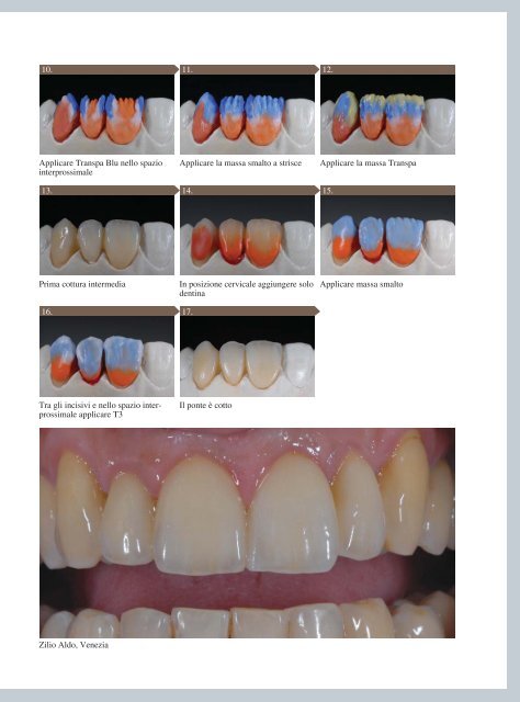 tecnologia di fresatura della zirconia - Zirkonzahn