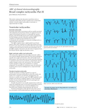 ABC of clinical electrocardiography Broad complex tachycardia ...