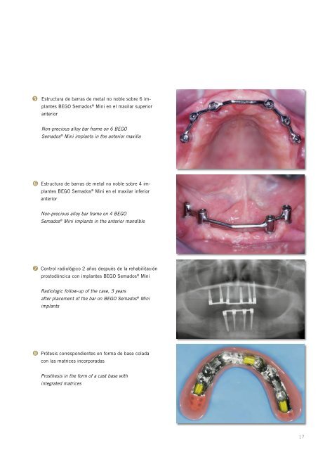 Implantes Mini - BEGO