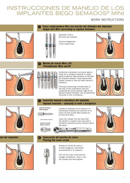 Implantes Mini - BEGO