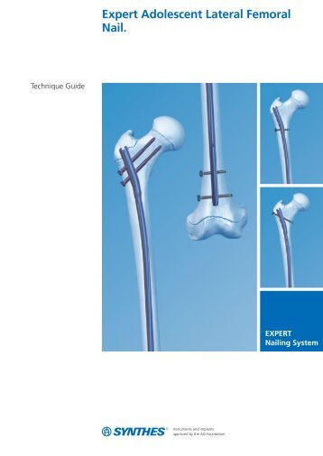 Expert Adolescent Lateral Femoral Nail. - Osteosyntese