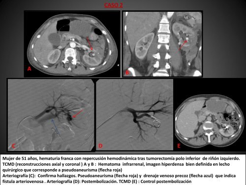 Hemorragia renal grave: Radiología vascular intervencionista