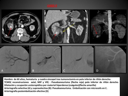 Hemorragia renal grave: Radiología vascular intervencionista