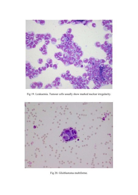 CSF/brain smear cytology - Rcpa.tv