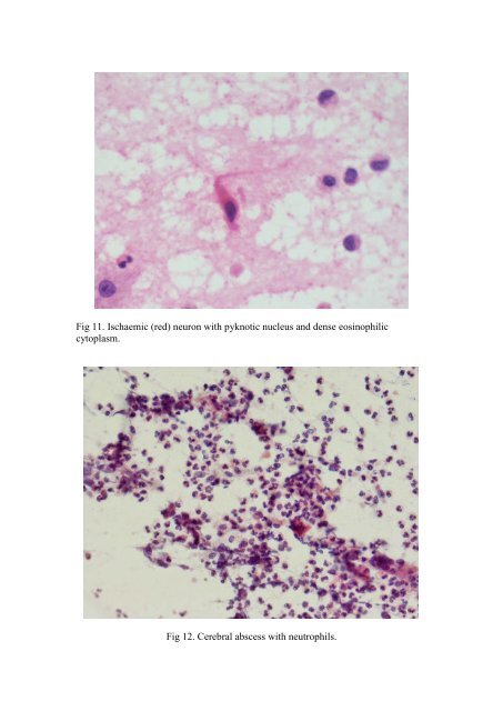 CSF/brain smear cytology - Rcpa.tv