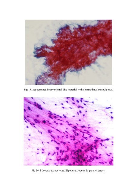 CSF/brain smear cytology - Rcpa.tv