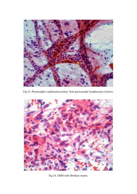 CSF/brain smear cytology - Rcpa.tv