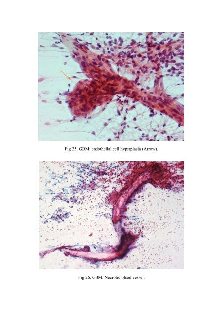 CSF/brain smear cytology - Rcpa.tv